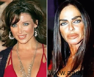 چهره ی زشت سلبریتی ها با تزریق افراطی بوتاکس