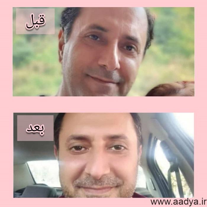 نمونه تزریق بوتاکس صورت مردان مرکز شریعتی تهران